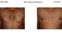 Male-Breast-Reduction-1