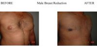 Male-Breast-Reduction-2