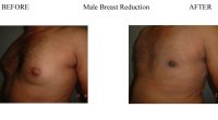 Male-Breast-Reduction-3