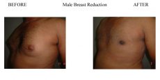 Male-Breast-Reduction-3
