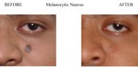 Melanocytic-Neavus-1