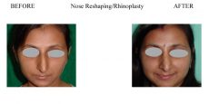 Nose-Reshaping-Rhinoplasty-1