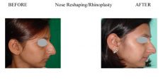 Nose-Reshaping-Rhinoplasty-4