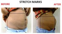 Stretch-Marks-10