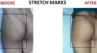Stretch-Marks-4