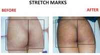 Stretch-Marks-5