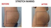 Stretch-Marks-6
