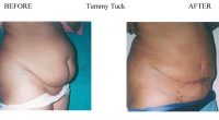 Tummy-Tuck-11