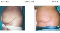 Tummy-Tuck-12