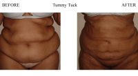 Tummy-Tuck-2