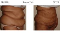 Tummy-Tuck-3