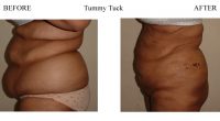 Tummy-Tuck-6