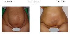 Tummy-Tuck-7