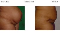 Tummy-Tuck-8