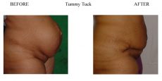 Tummy-Tuck-8