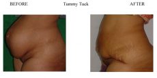 Tummy-Tuck-9