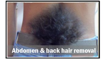 abdomen-&-back-hair-removal