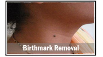 birthmark-removal