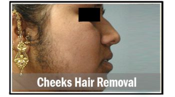 cheeks-hair-removal