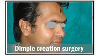 dimple-creation-surgery