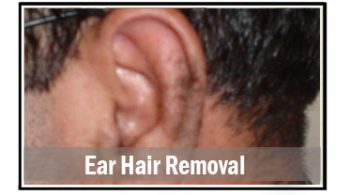 ear-hair-removal