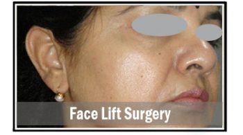face-lift-surgery