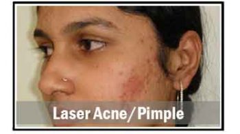 laser-acne-pimple