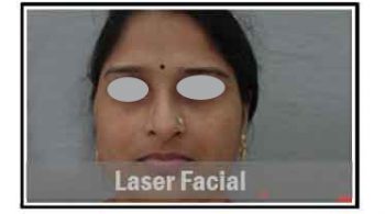 laser-facial