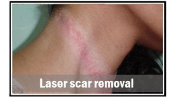 laser-scar-removal