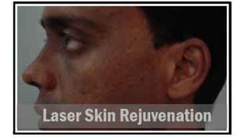laser-skin-rejuvenation