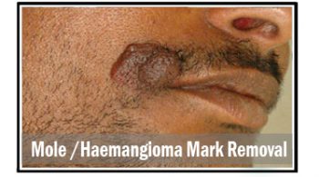 mole-haemangioma
