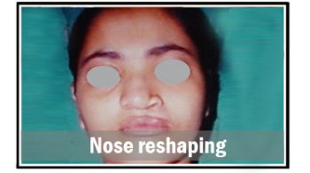 nose-reshaping-1
