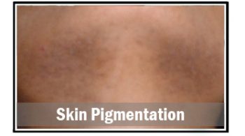 skin-pigmentation-1