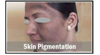 skin-pigmentation