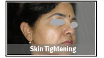 skin-tightening