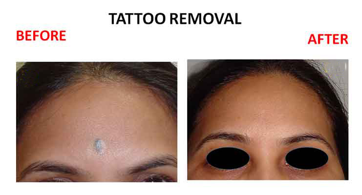 Laser Tattoo Removal - Stock Image - C012/3824 - Science Photo Library