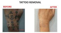 tatto-removal10