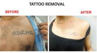 tatto-removal13