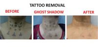 tatto-removal2