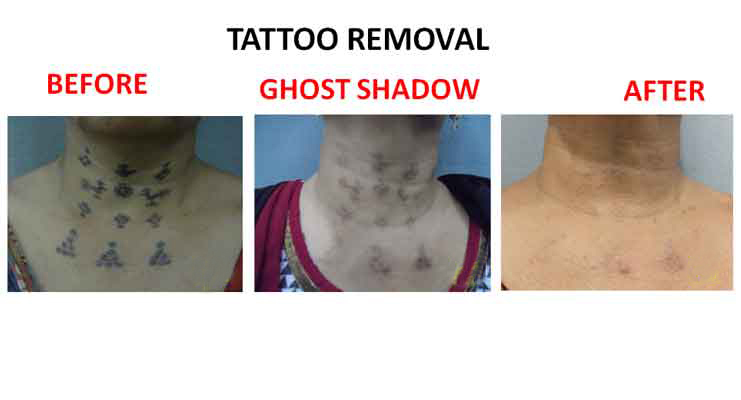 Laser Tattoo Removal | Painless Laser Tattoo Removal at Dermatrix following  complete Covid-19 protocols. Call +91 93215 25677 to book appointments. . .  . #clinicscenes... | By Dermatrix-Encoding The Body MatrixFacebook