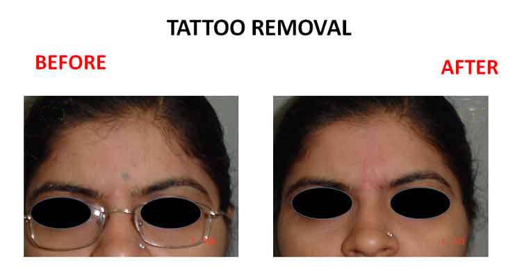 Laser Removal of Permanent Makeup - TANIA BHANGOO PERMANENT MAKEUP
