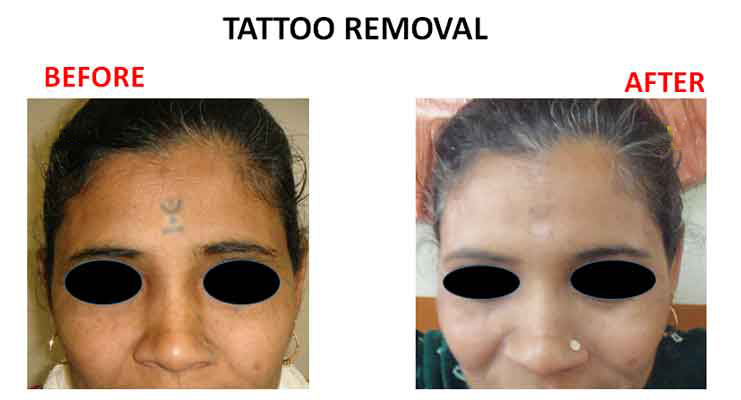 Laser Tattoo Removal – Amrit Clinic