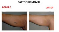 tatto-removal7
