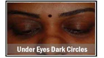 under-eyes-dark-circles