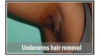 underarms-hair-removal
