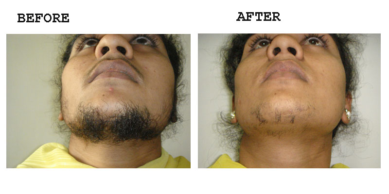 Chin front of neck – Amrit Clinic