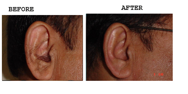 Ear Hair Removal – Amrit Clinic