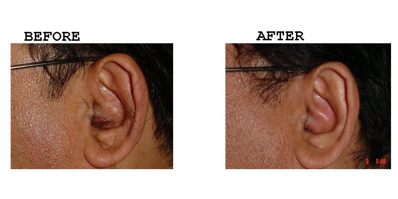Ear Hair Removal – Amrit Clinic