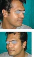 Before treatment